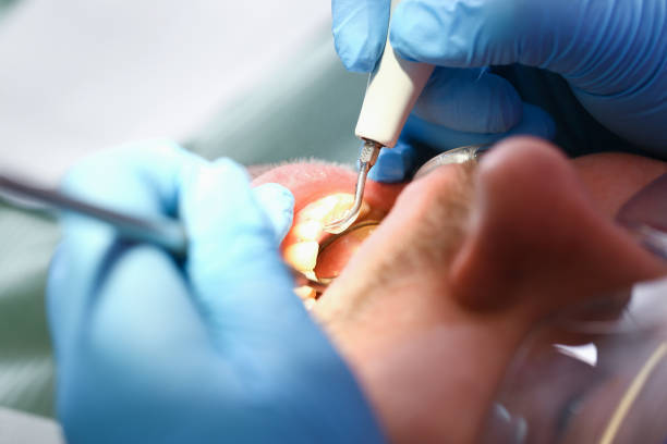 Best Emergency Dental Care for Abscessed Tooth in Rodeo, CA